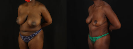 Tummy Tuck case #7780