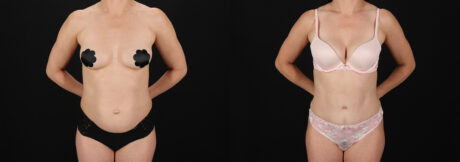 Tummy Tuck case #7776