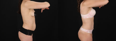 Tummy Tuck case #7776