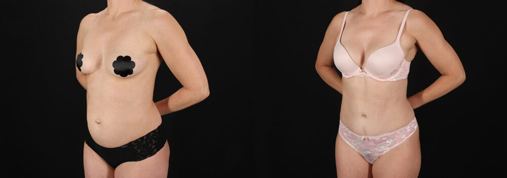 Tummy Tuck case #7776