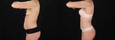 Tummy Tuck case #7776