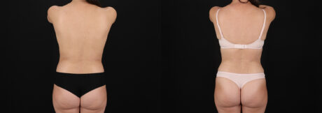 Tummy Tuck case #7776