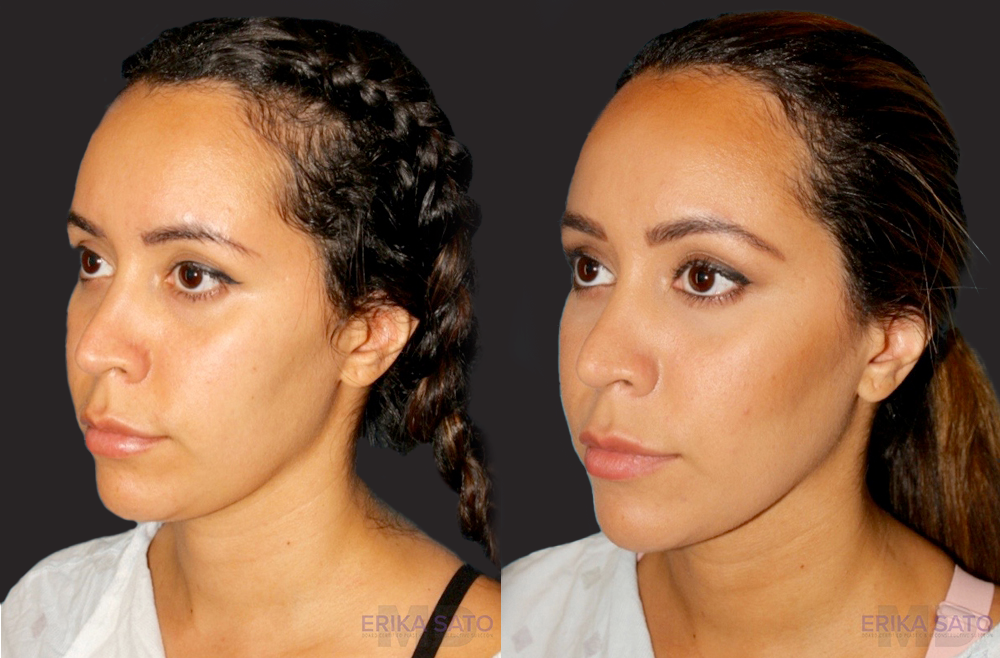 Submental Liposuction case #6943