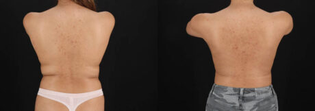 Breast Augmentation case #6462