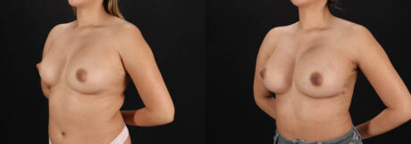 Breast Augmentation case #6462