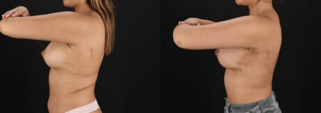 Breast Augmentation case #6462