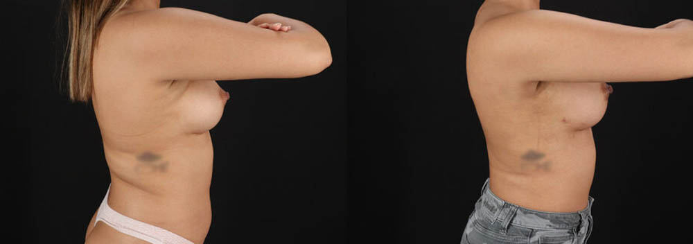 Breast Augmentation case #6462