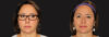 Submental Liposuction case #6945 slider thumbnail