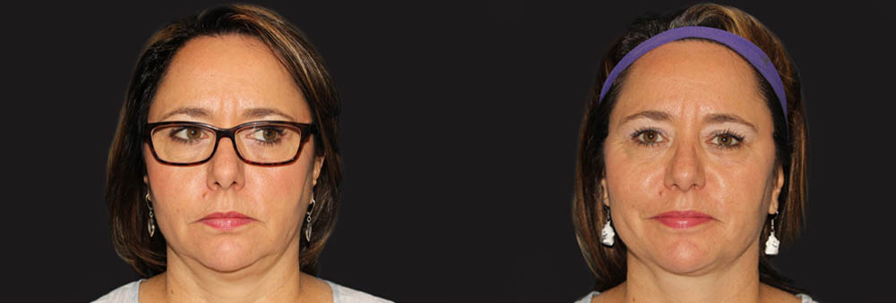 Submental Liposuction case #6945