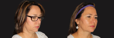 Submental Liposuction case #6945