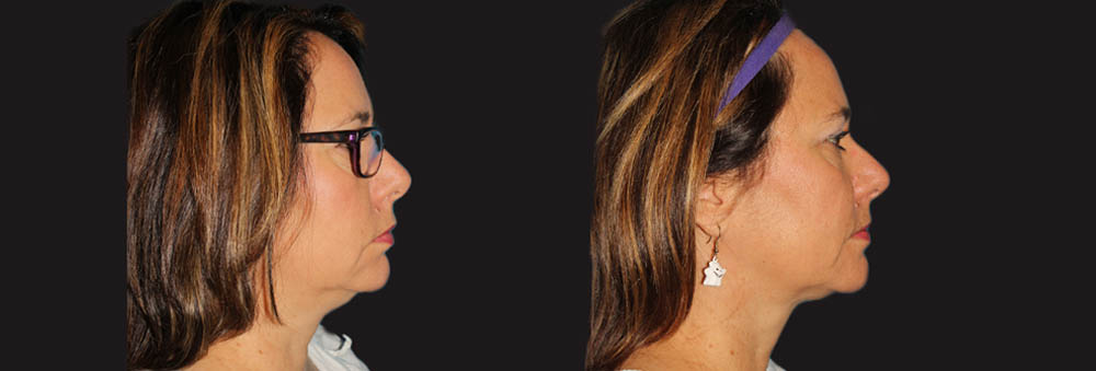 Submental Liposuction case #6945