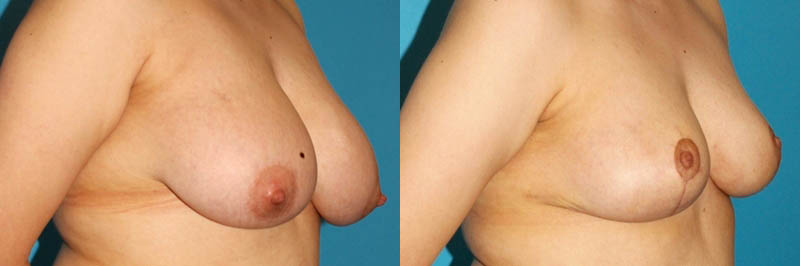 Breast Reduction case #7950