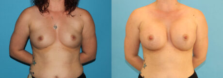 Breast Augmentation case #5649