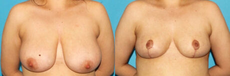 Breast Reduction case #7950