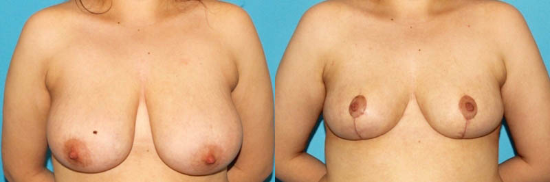 Breast Reduction case #7950