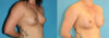 Breast Augmentation case #5649 slider thumbnail