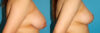 Breast Reduction case #7950 slider thumbnail