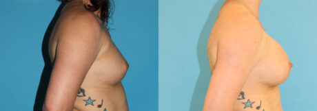 Breast Augmentation case #5649