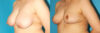 Breast Reduction case #7950 slider thumbnail