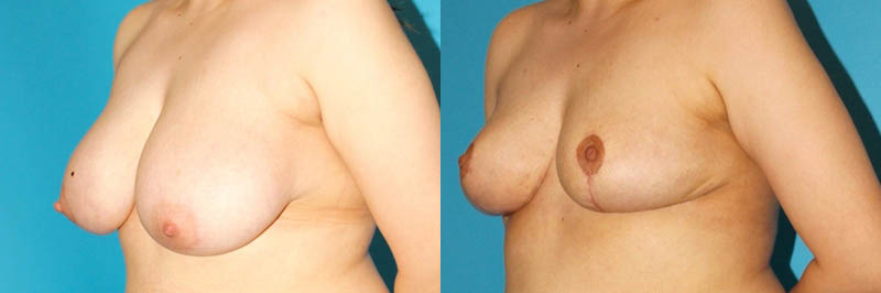 Breast Reduction case #7950