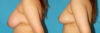 Breast Reduction case #7950 slider thumbnail