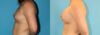 Breast Augmentation case #5649 slider thumbnail
