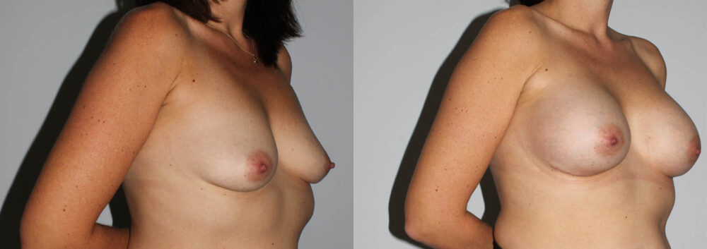 Breast Augmentation case #5622