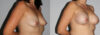 Breast Augmentation case #5622 slider thumbnail