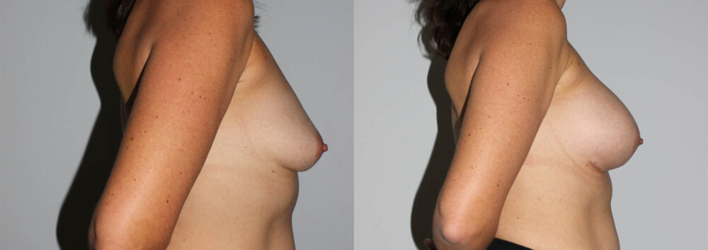 Breast Augmentation case #5622