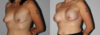 Breast Augmentation case #5622 slider thumbnail
