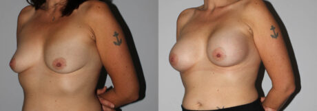 Breast Augmentation case #5622