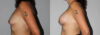 Breast Augmentation case #5622 slider thumbnail