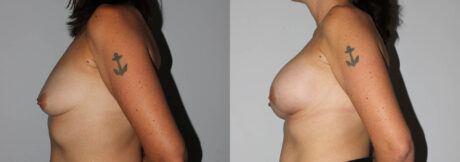 Breast Augmentation case #5622