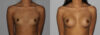 Breast Augmentation case #5640 slider thumbnail