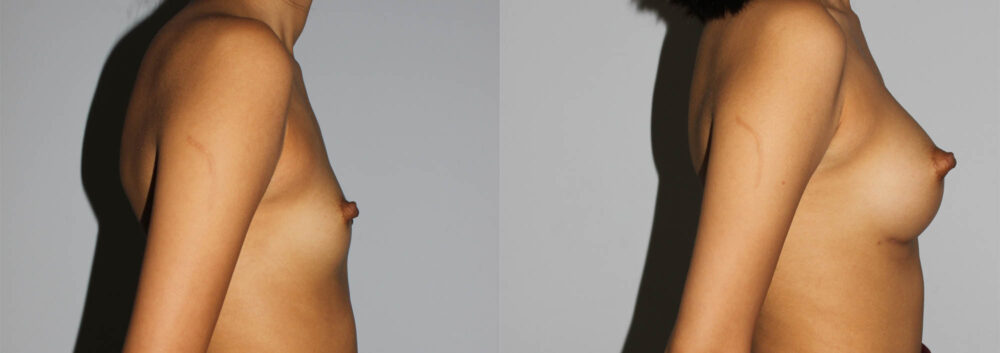 Breast Augmentation case #5640