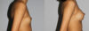 Breast Augmentation case #5640 slider thumbnail