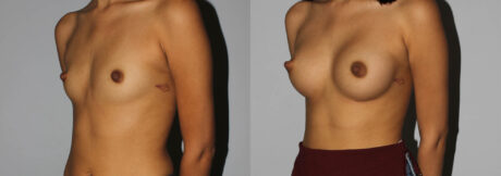 Breast Augmentation case #5640