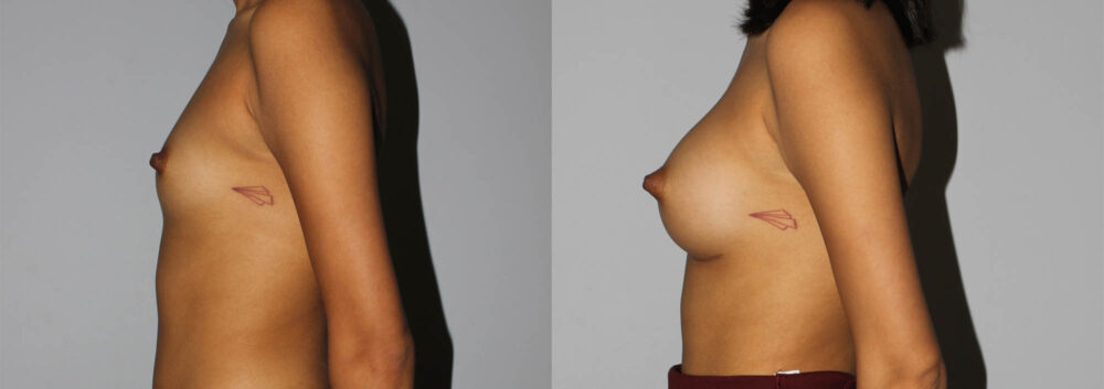 Breast Augmentation case #5640
