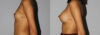 Breast Augmentation case #5640 slider thumbnail