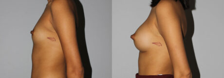 Breast Augmentation case #5640