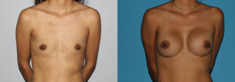 Breast Augmentation case #5618