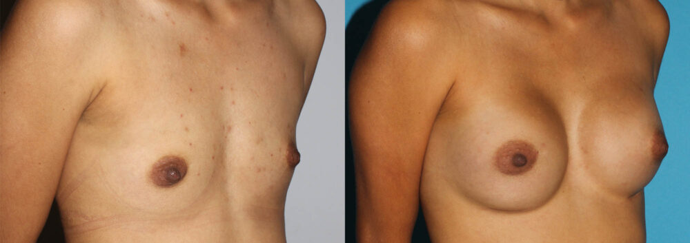 Breast Augmentation case #5618