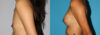 Breast Augmentation case #5618 slider thumbnail