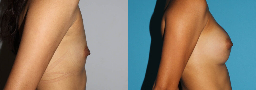 Breast Augmentation case #5618