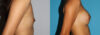 Breast Augmentation case #5618 slider thumbnail