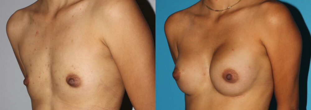 Breast Augmentation case #5618