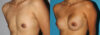 Breast Augmentation case #5618 slider thumbnail