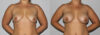 Breast Augmentation case #5607 slider thumbnail
