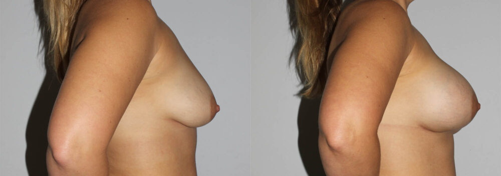 Breast Augmentation case #5607