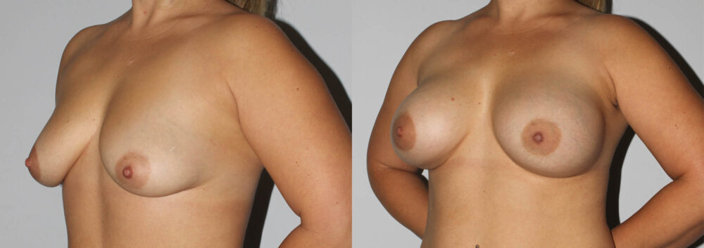 Breast Augmentation case #5607